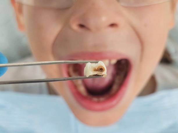 Best Emergency Dentist for Knocked-Out Tooth in East Patchogue, NY